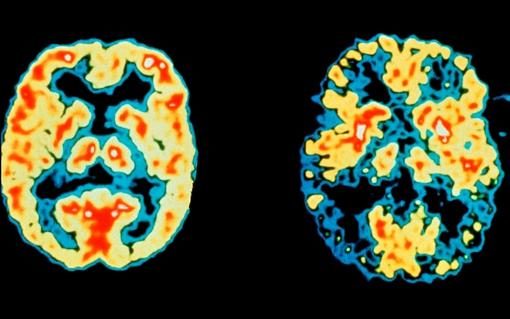 Brain: normal (left) alzheimer (right)