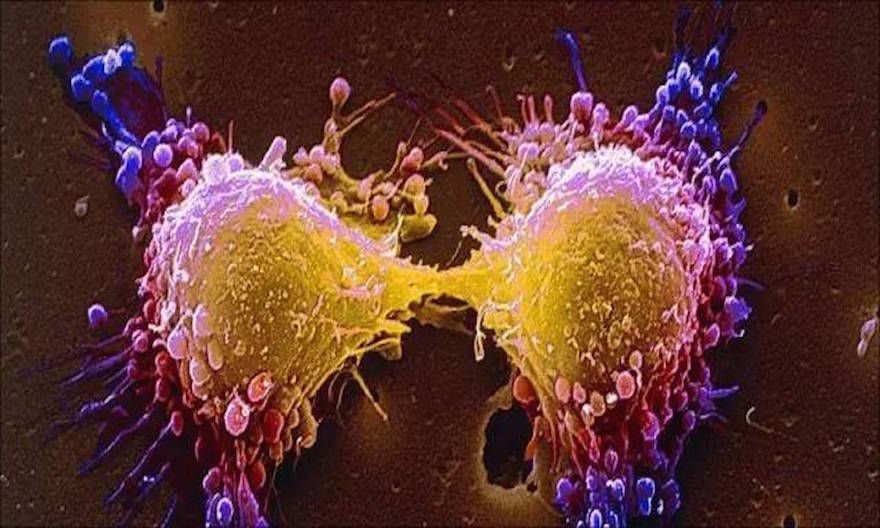 Cancro, possibili nuove strategie per affamare le cellule tumorali