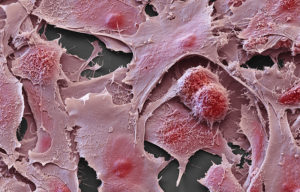 cancerseek rivela otto tipi di tumore