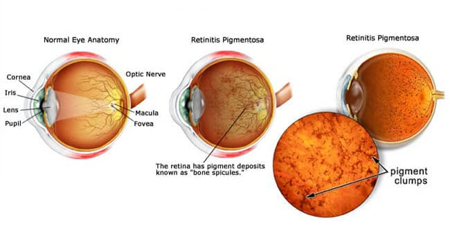 Una sonda CRISPR contro la retinite pigmentosa: dalla Columbia arrivano buoni risultati