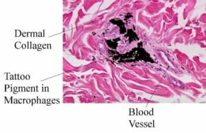 macrofagi validi alleati contro i tatuaggi